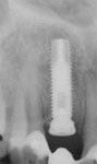 Röntgenbild mit Implantat Röntgenbild mit Schraubimplantat