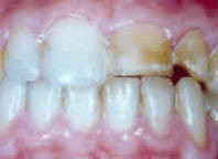 Regelmäßige Prophylaxe gegen Verfärbungen & Zahnerkrankungen Stark verfärbte Zähne